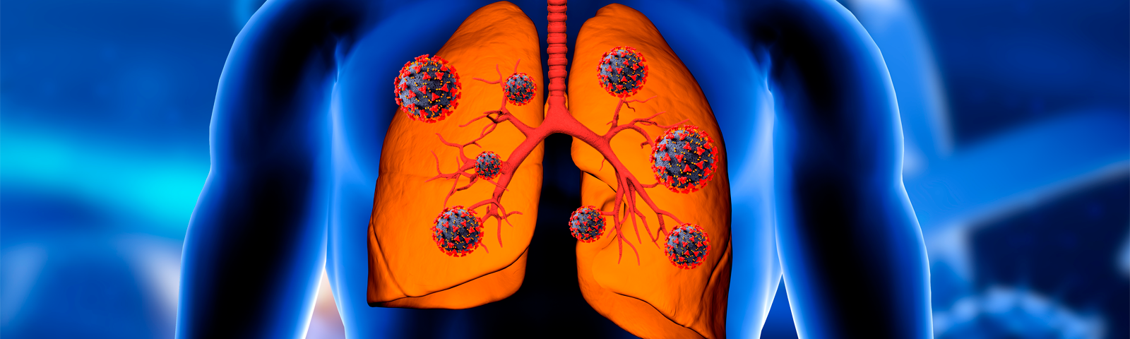Broncopulmonar: Diagnóstico y Tratamiento en Clínica Bupa Santiago