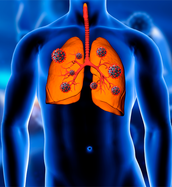 Broncopulmonar: Diagnóstico y Tratamiento en Clínica Bupa Santiago