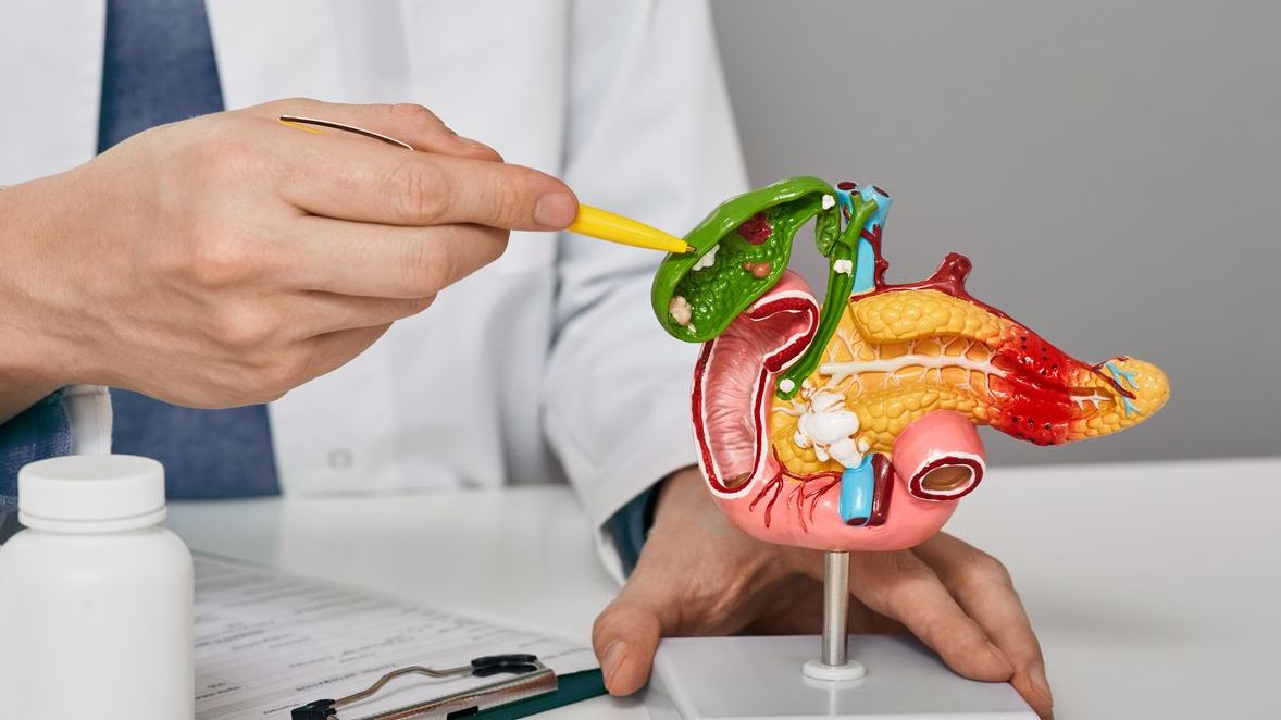 Bono PAD Colelitiasis