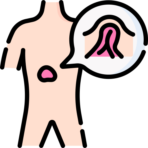 Hernia epigástrica