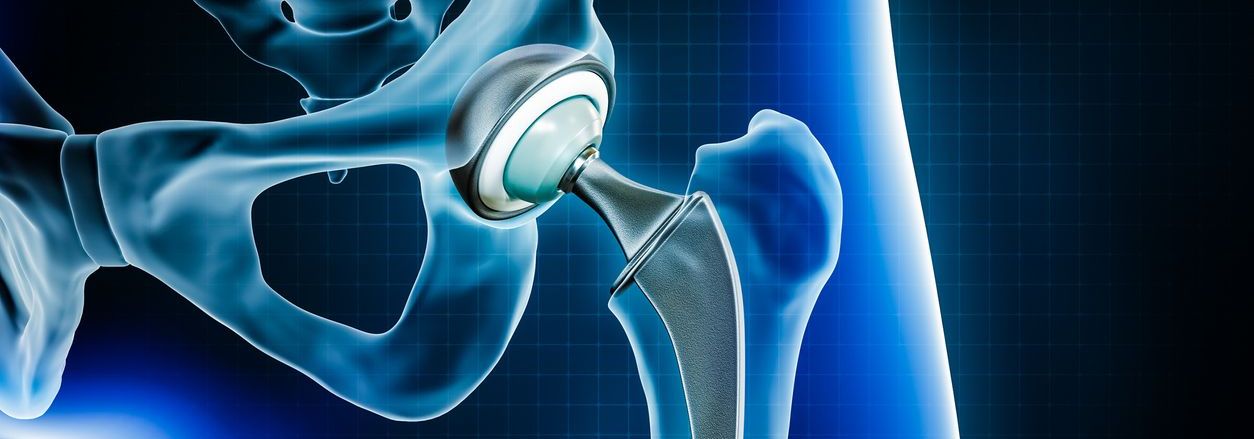 Tu cirugía de prótesis de cadera con SAP Fonasa
