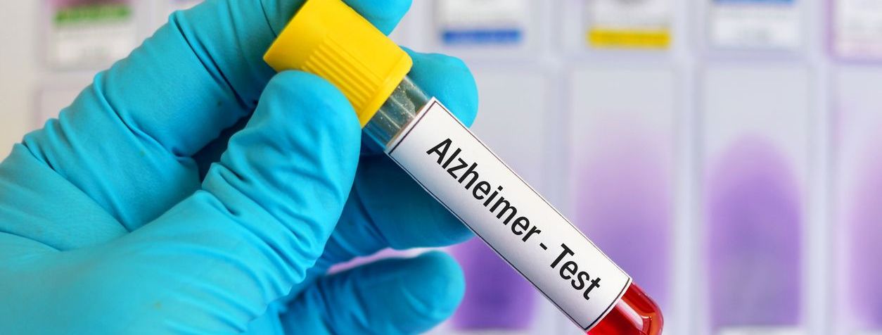Nuevo examen para detectar Alzheimer a tiempo